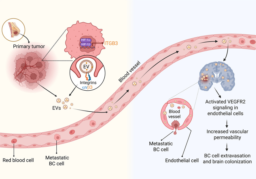 HIF-1–dependent expression of ITGB3 incorporated into EVs promotes BC br...