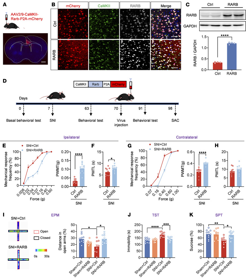 RARB overexpression in ACC relieves pain hypersensitivity and anxiodepre...