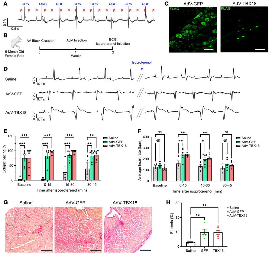 Injection of AdV vectors leads to ectopic pacing in a complete AV-block ...
