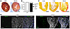AAV-mediated TBX18 overexpression induces cardiac fibrosis in mouse hearts.