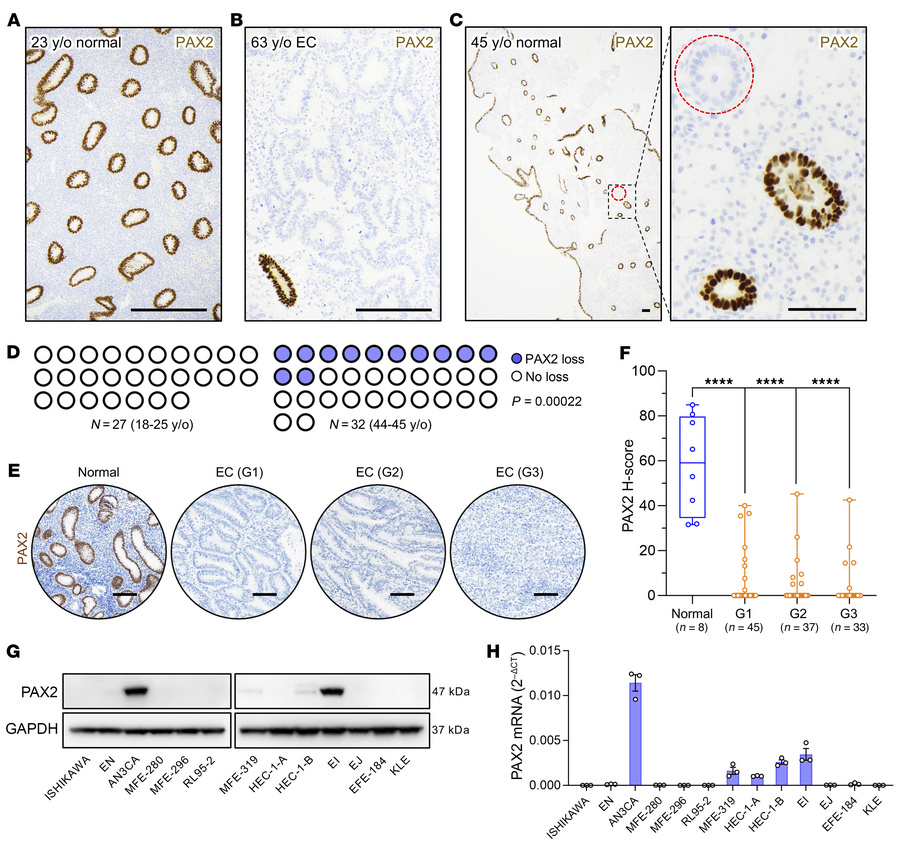 Emergence of PAX2-deficient clones in endometrial epithelium is age depe...