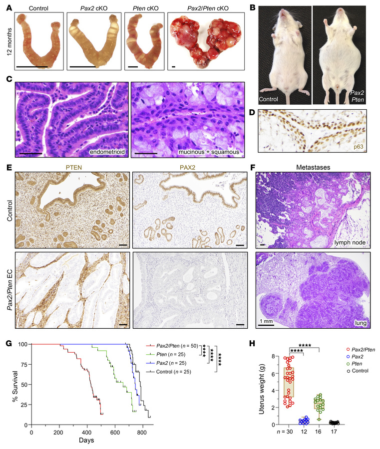 
Pax2 is an EC tumor suppressor synergizing with Pten in vivo.
(A) Uteri...