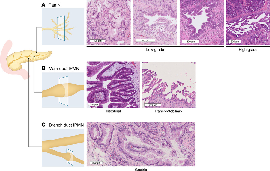 PanIN and IPMN anatomy and histological features.
(A) PanINs arise from ...