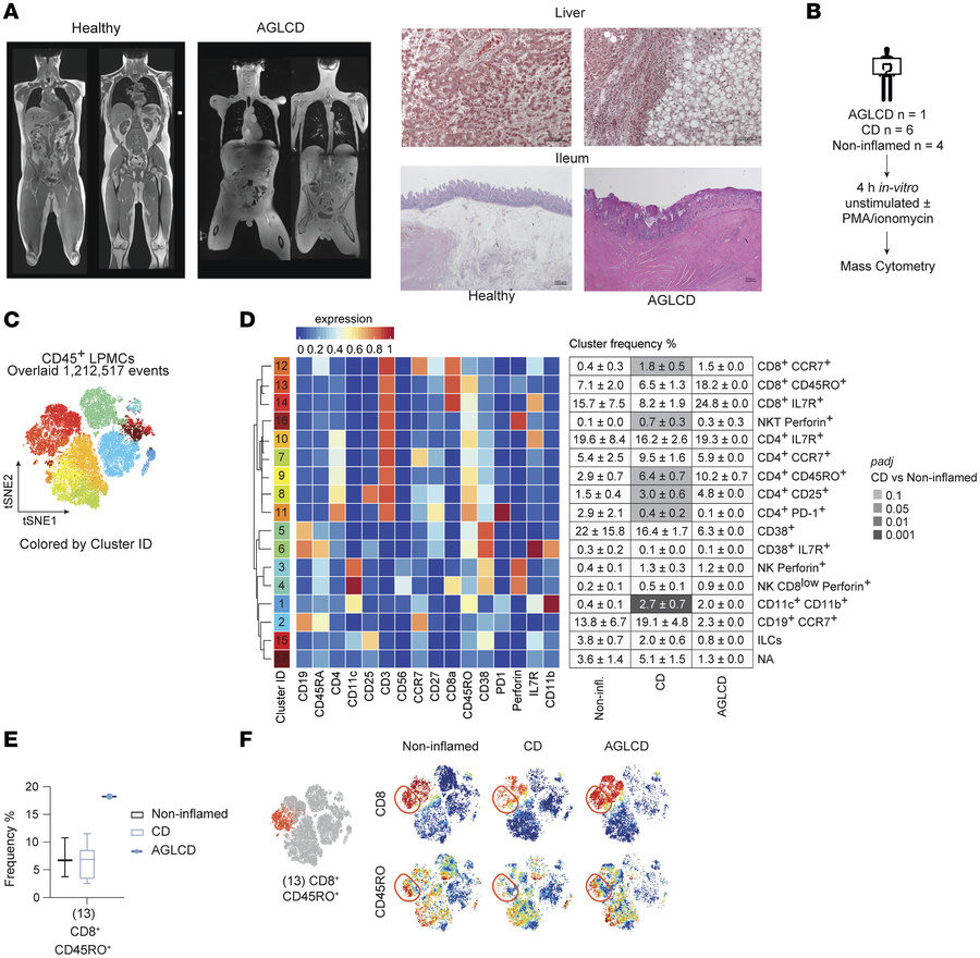 Enrichment of T cells in the small intestinal lamina propria in a patien...