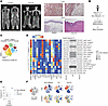 Enrichment of T cells in the small intestinal lamina propria in a patient w