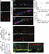LC morphological analysis in patients with PDN.
