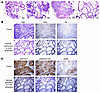 PCa development in probasin-rtTA; tetO-ERG; Pten-/+ mice.
