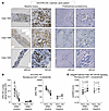 PI3K_AKT_MTOR activity in primary PCa before and after neoadjuvant AR-targe