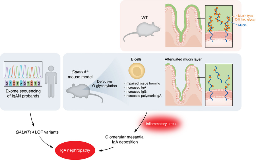 Loss of GalNAc-T14 connects IgAN-related phenotypes.
Whole exome sequenc...