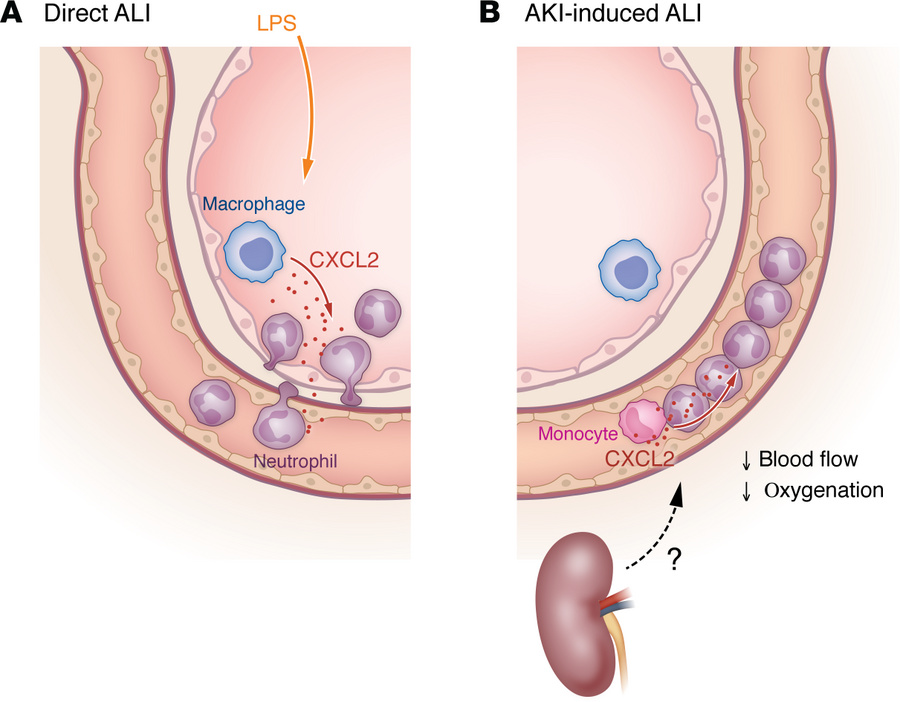 Direct and AKI-induced ALI result in different neutrophil chemotaxis pat...