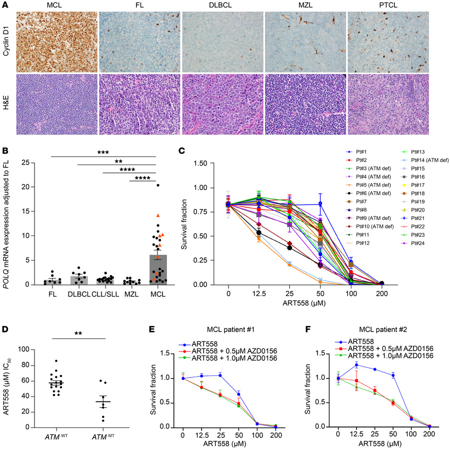 
POLQ is overexpressed in MCL compared with other NHLs, and its inhibiti...