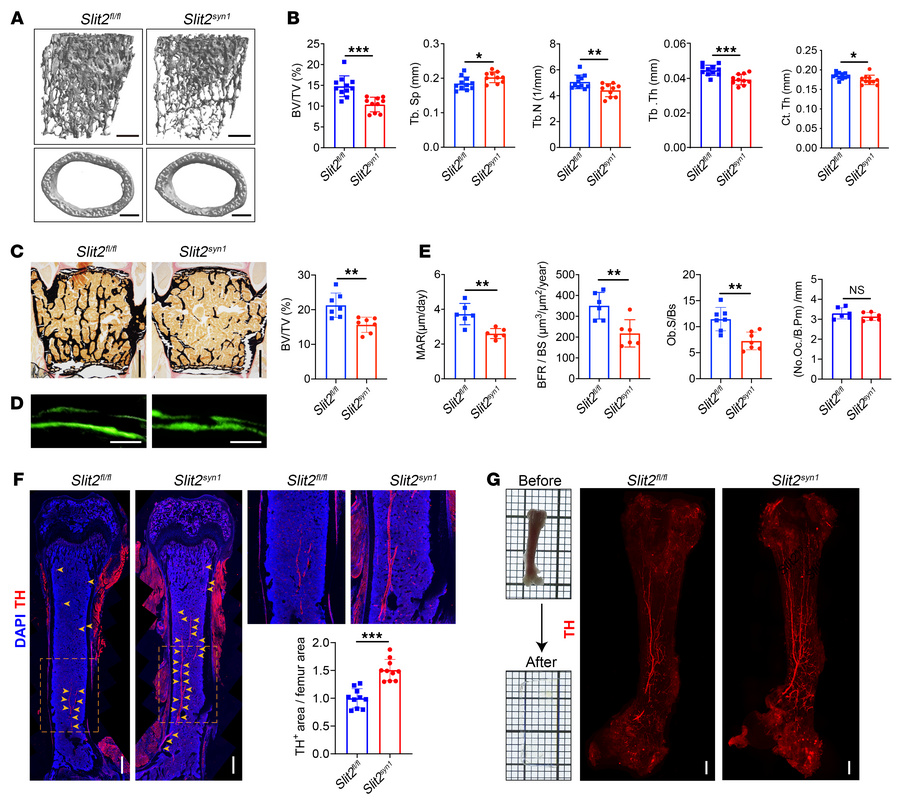 Bone loss, impaired bone formation, and sympathetic hyperinnervation in ...