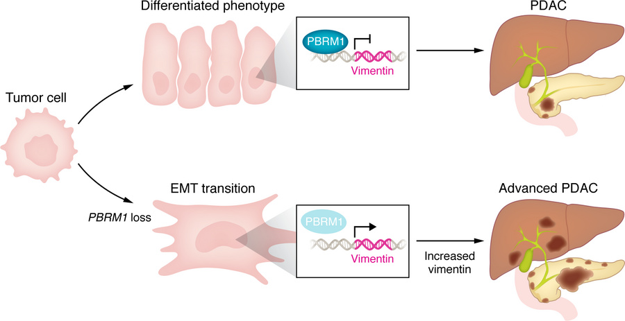 PBRM1 is a gatekeeper of PDAC evolutionary potential.
PBRM1 has a role i...