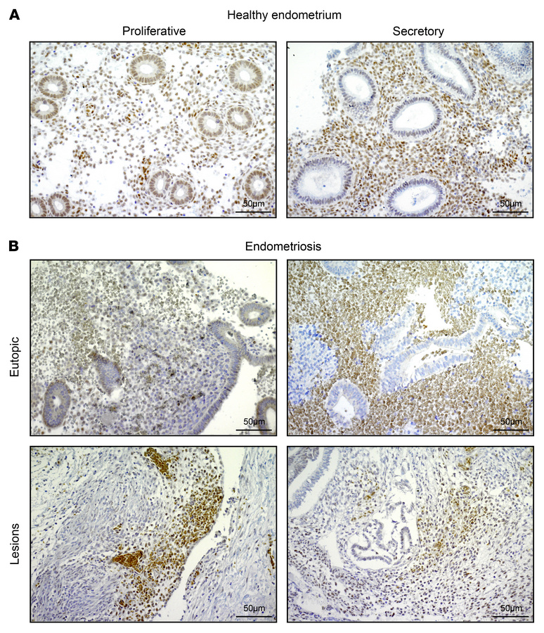 ZMIZ1 expression in human healthy and endometriosis endometrium and lesi...