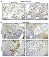 ZMIZ1 expression in human healthy and endometriosis endometrium and lesions