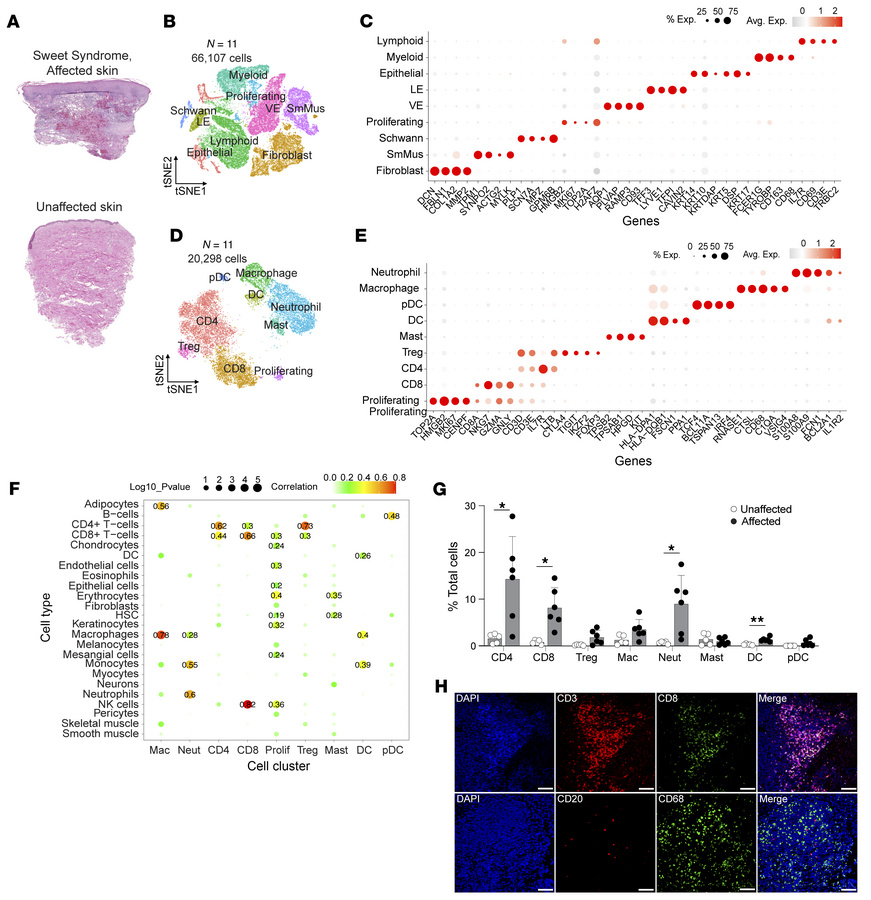 Immune cell landscape in Sweet syndrome.
(A) H&amp;E staining of affecte...