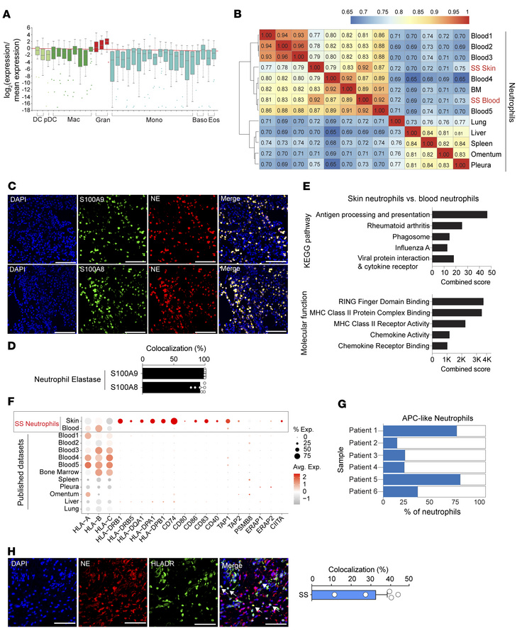 APC-like neutrophils are specifically recruited to Sweet syndrome–affect...