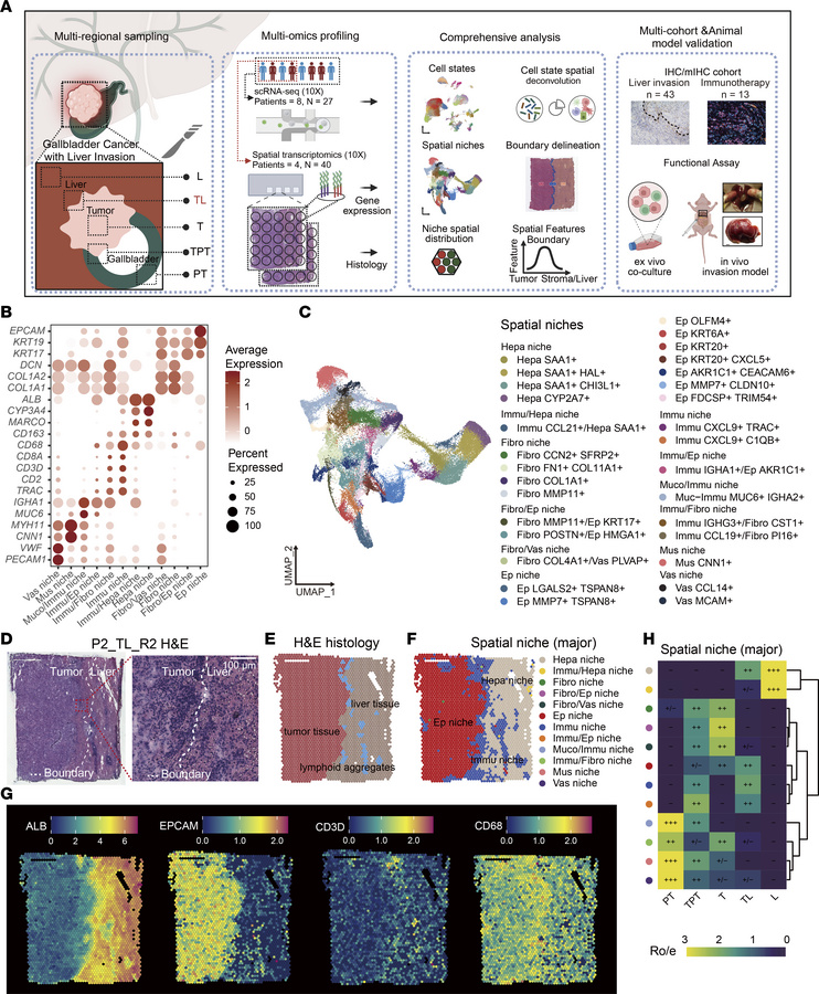 The spatial and single-cell landscape of GBC with direct liver invasion....