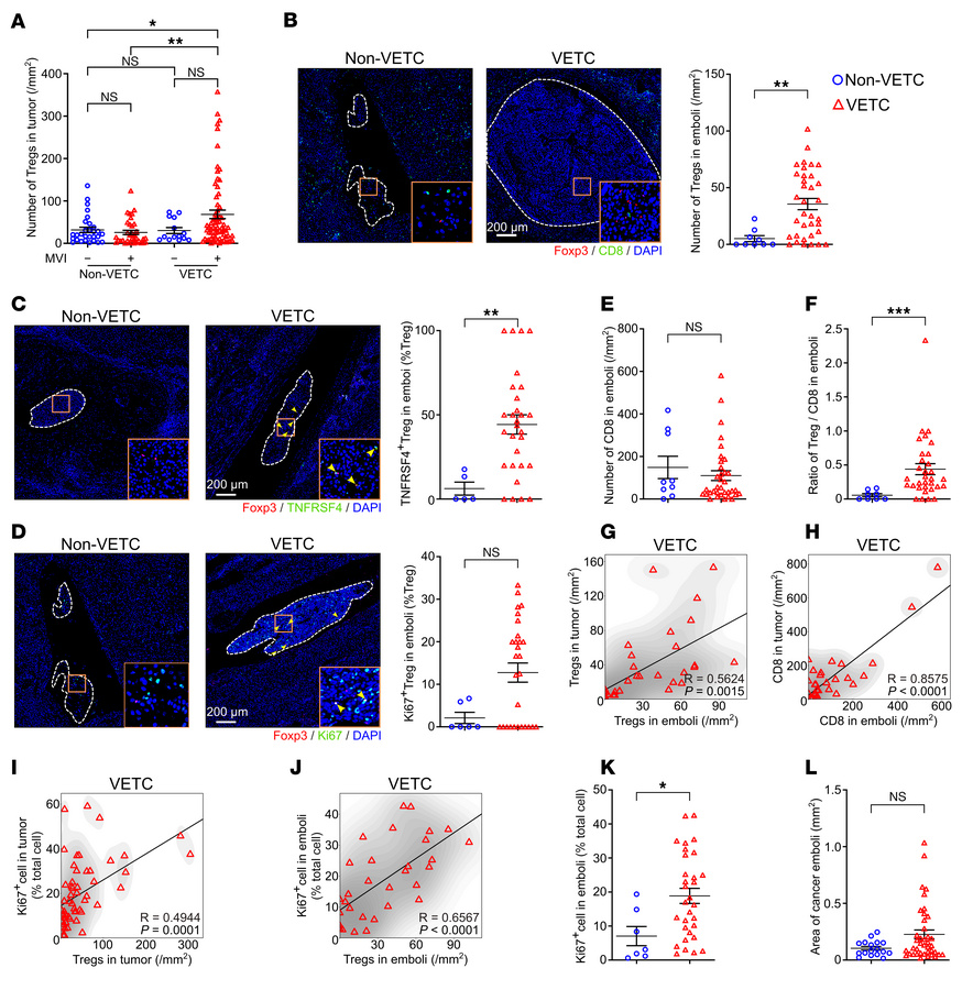 Tumor emboli in human VETC HCCs retain an immunosuppressive niche simila...