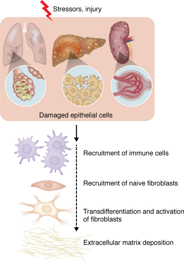 Common steps in organ fibrosis.
Multiple metabolic and inflammatory stre...