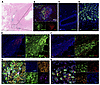 Bilirubin accumulates in immune graft-infiltrates in CAV.