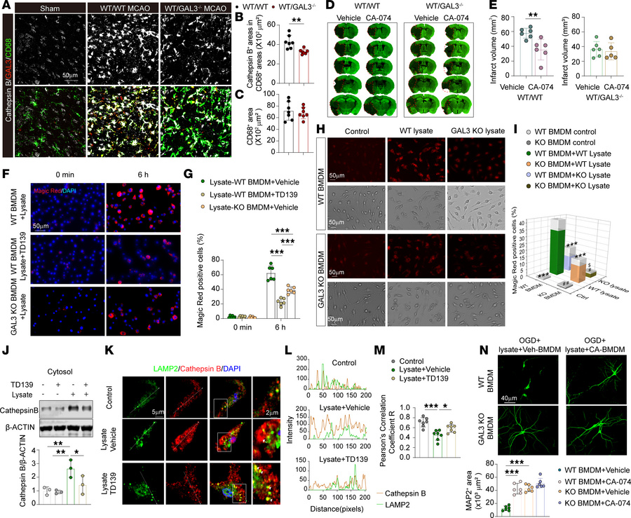 High GAL3 expression in MDMø amplifies cathepsin induction and leakage a...