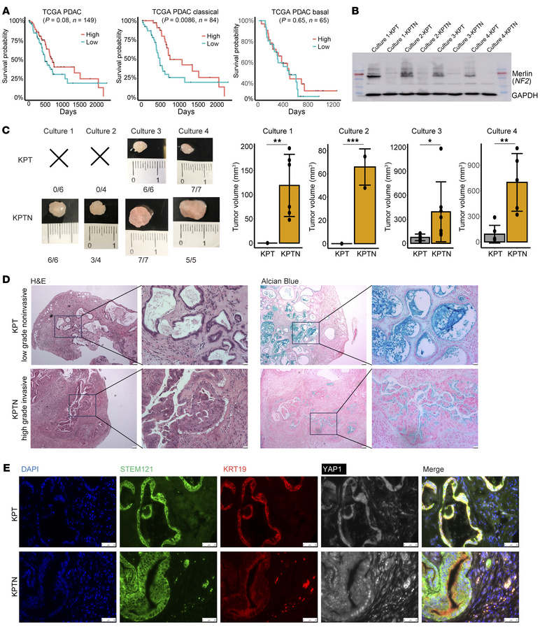 Loss of NF2 facilitates aggressive progression of acinar-derived human P...