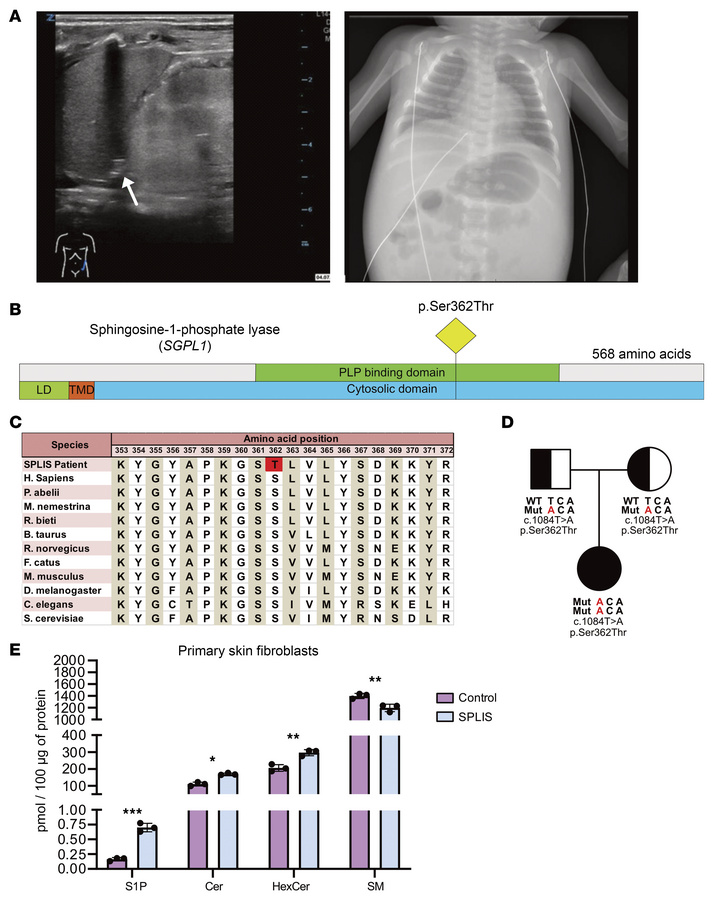 Clinical and molecular characterization of the new SPLIS-causing SGPL1 m...