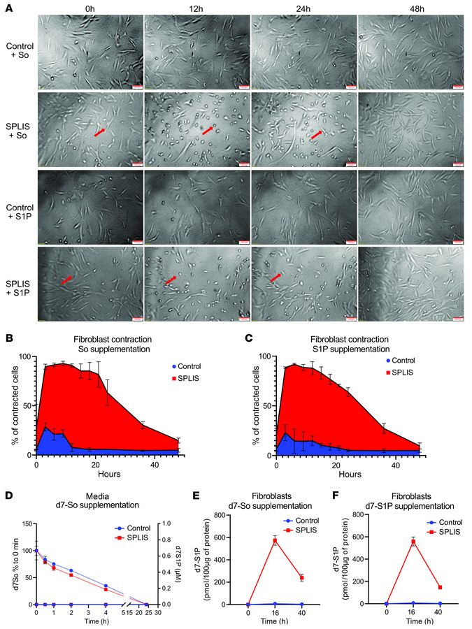 Cytoskeletal dynamics and lipid metabolism in SPLIS fibroblasts after So...