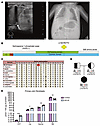 Clinical and molecular characterization of the new SPLIS-causing SGPL1 muta
