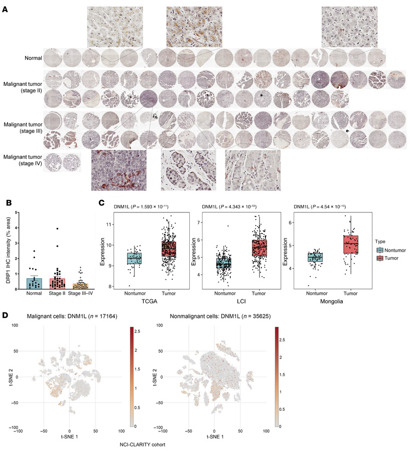 Heterogeneity of DRP1/DNM1L expression in human HCC samples.
(A) IHC sta...
