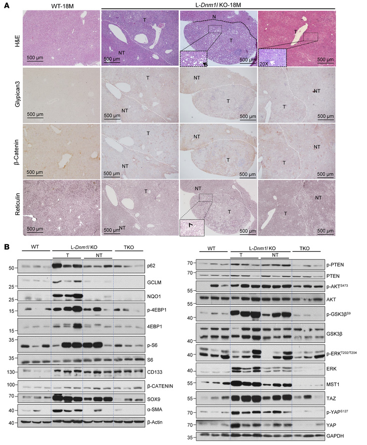 Hepatocellular adenoma in L-Dnm1l–KO mice.
(A) Representative H&amp;E an...