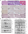 Hepatocellular adenoma in L-Dnm1l–KO mice.