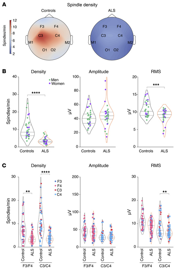 Sleep spindle alterations in patients with early-stage ALS.
(A) Topograp...