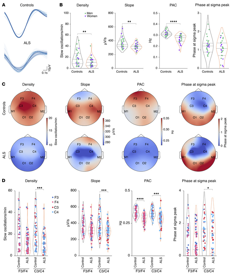 Slow oscillation alterations in patients with early-stage ALS.
(A) Repre...