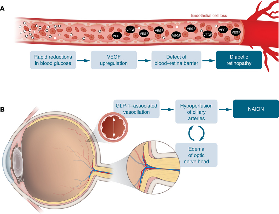 Hypothesized mechanisms for ocular complications associated with GLP-1RA...