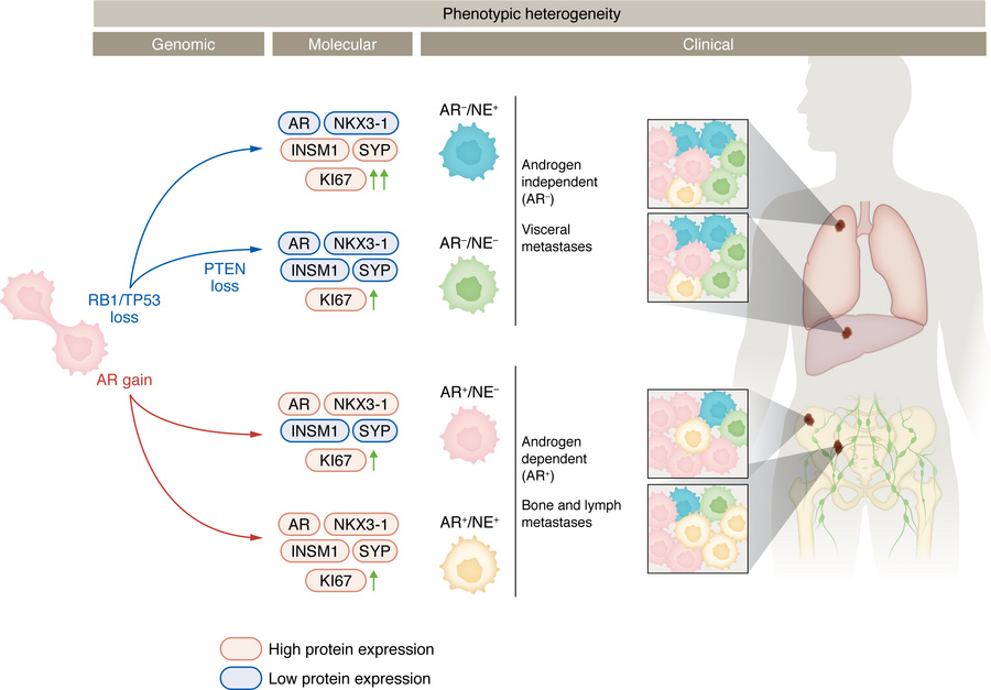 Metastatic PC shows phenotypic heterogeneity.
Treated metastatic PC cell...