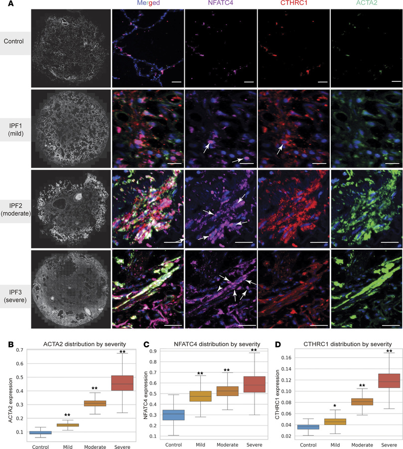 
NFATC4, CTHRC1, and ASMA expression increases with IPF disease severity...