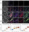 NFATC4, CTHRC1, and ASMA expression increases with IPF disease severity in