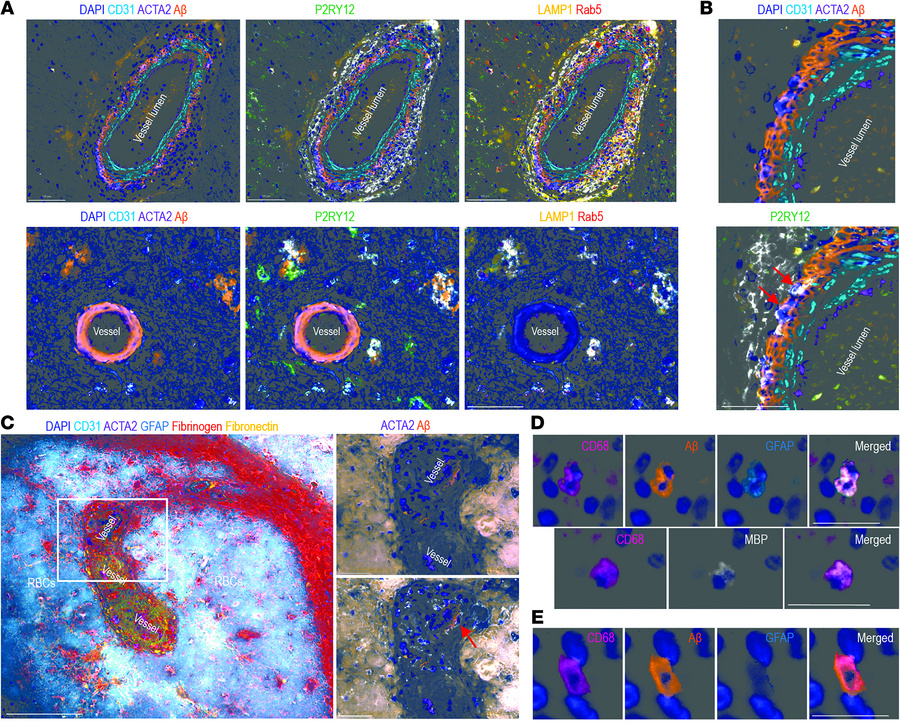 Spatial proteomic multiplex immunofluorescence analysis comparing a leca...