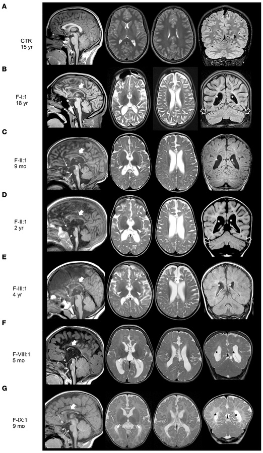 Neuroimaging findings in individuals with BORCS5 missense and splice-sit...