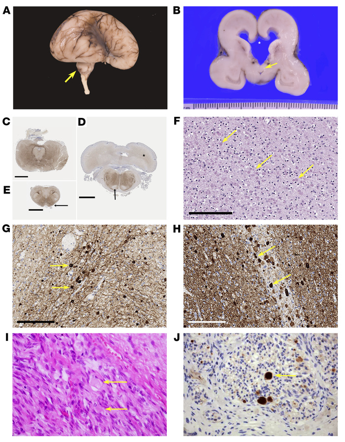 Pathological characterization of cases with bi-allelic LoF BORCS5 varian...
