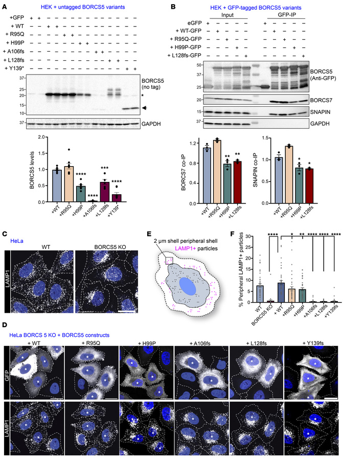 Impact of BORCS5 pathogenic variants on BORCS5 protein expression, BORC ...