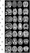 Neuroimaging findings in individuals with BORCS5 missense and splice-site v