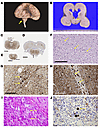Pathological characterization of cases with bi-allelic LoF BORCS5 variants.