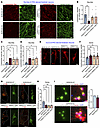 Lysosome-dispersal activity of patient-specific BORCS5 variants.