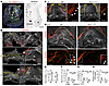 Development of LVs is inhibited in Fbn1 mutant MVs.