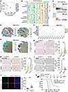 High OLIG2 expression positively correlates with the immunosuppressive TME