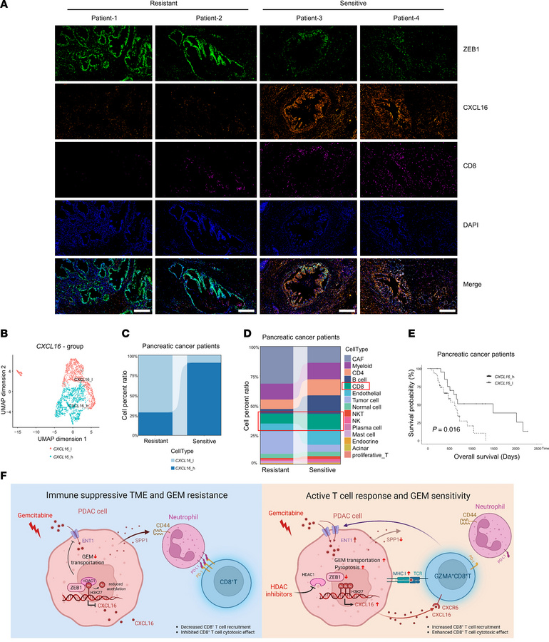 ZEB1 and CXCL16 are associated with chemotherapy resistance, immunosuppr...