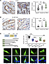 UGT2B17 protein expression is upregulated in CRPC patient tumors.